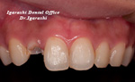 歯牙破折の治療例
