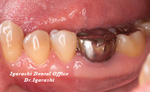 銀歯の治療例