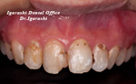 虫歯の治療例