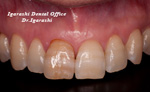 変色歯の治療例