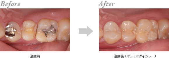 セラミック修復の治療例（詰め物・被せ物の交換） | 五十嵐歯科室