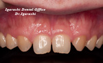 前歯の形態改善