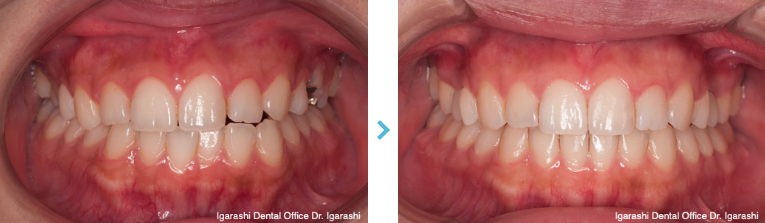 矮小歯・欠損歯をインビザライン矯正で治療した例