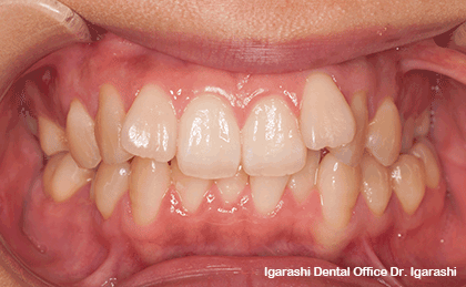 II級2類、臼歯クロスバイト、下顎偏位