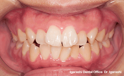 上下顎前突、口ゴボ、インビザライン非抜歯治療