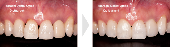 ブラックトライアングル、歯間鼓形空隙空隙、歯肉退縮の改善