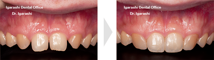 咬耗や形態異常の歯冠形態の回復